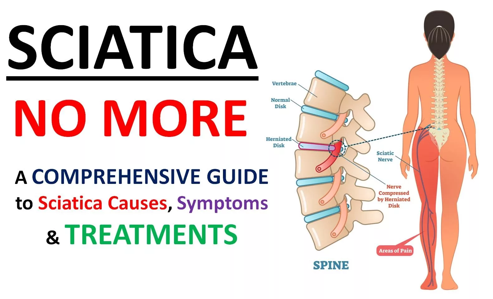 Sciatica: Symptoms and causes of sciatic nerve pain