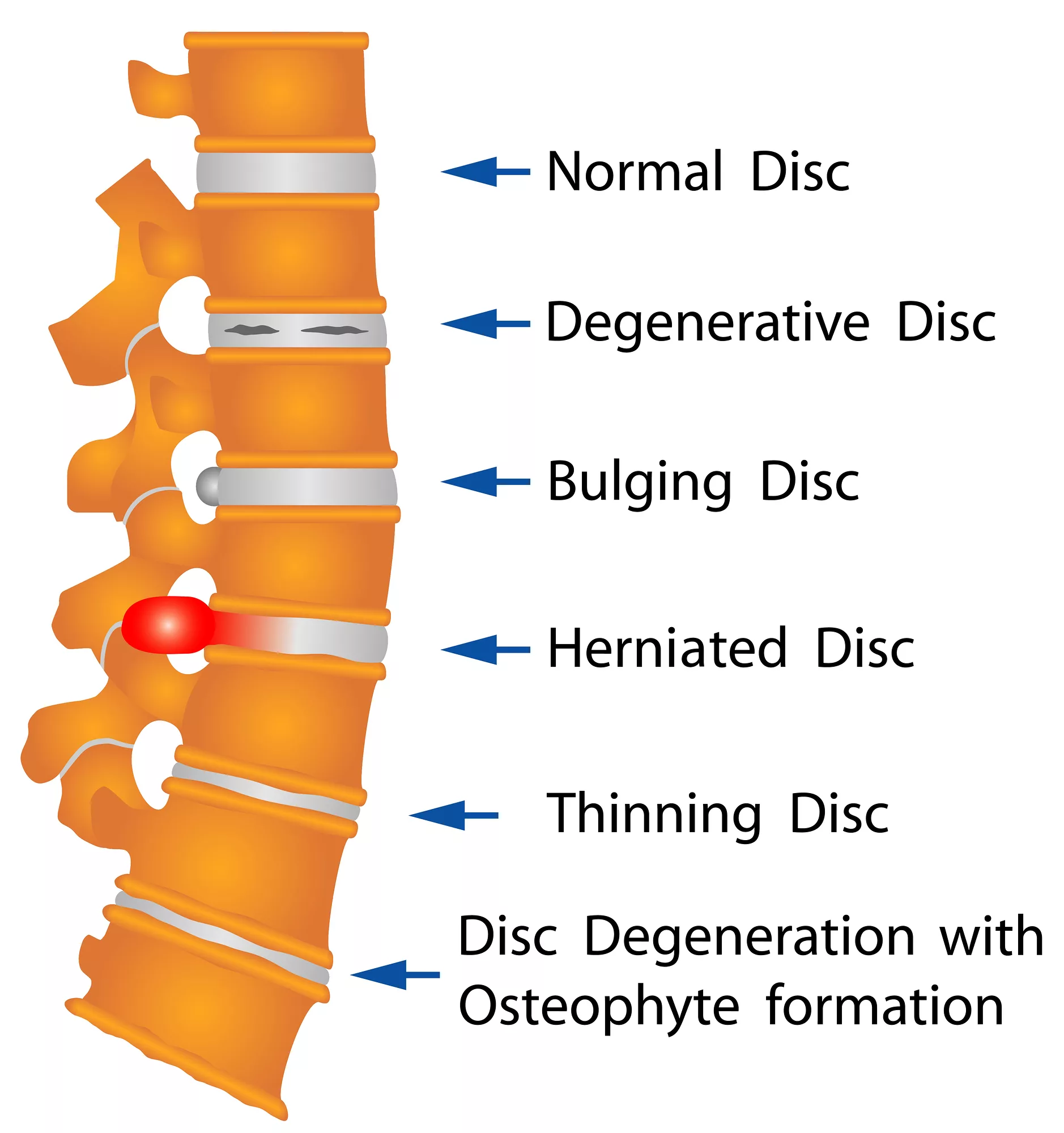 Herniated Disc: Causes, Symptoms, Treatment, and Prevention, ProActive  Physical Therapy Clinics