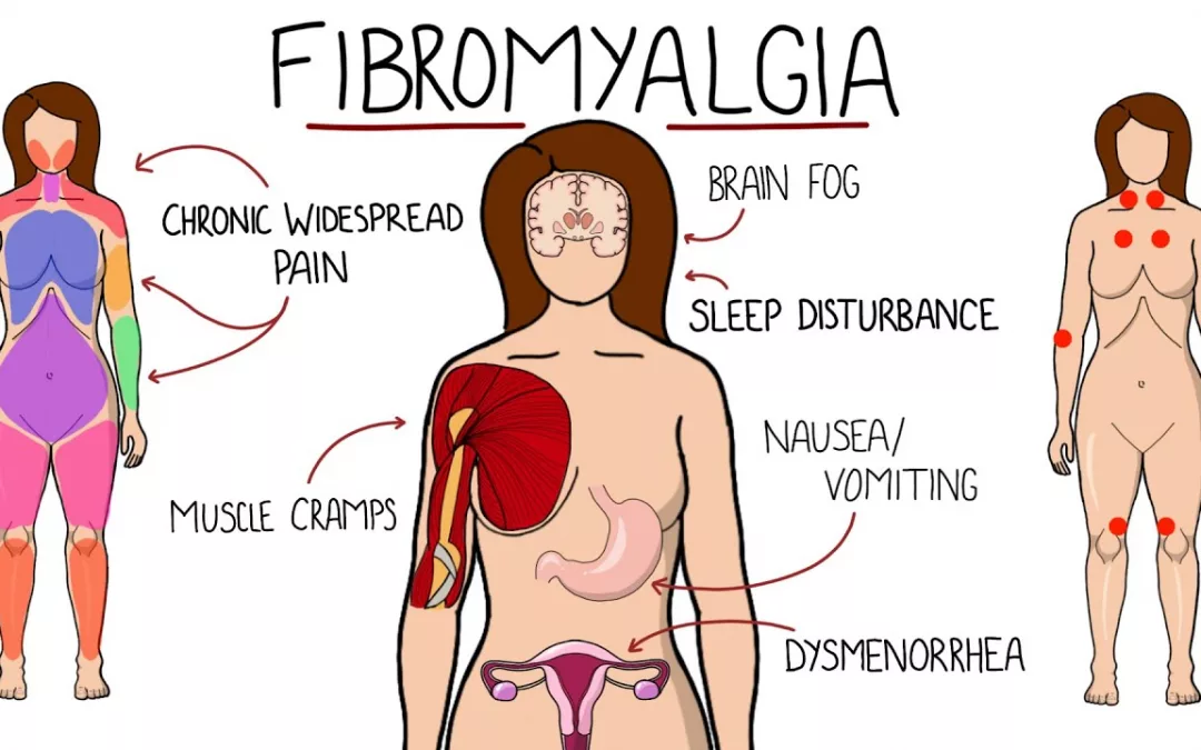 What is Fibromyalgia? What are the Symptoms of Fibromyalgia?