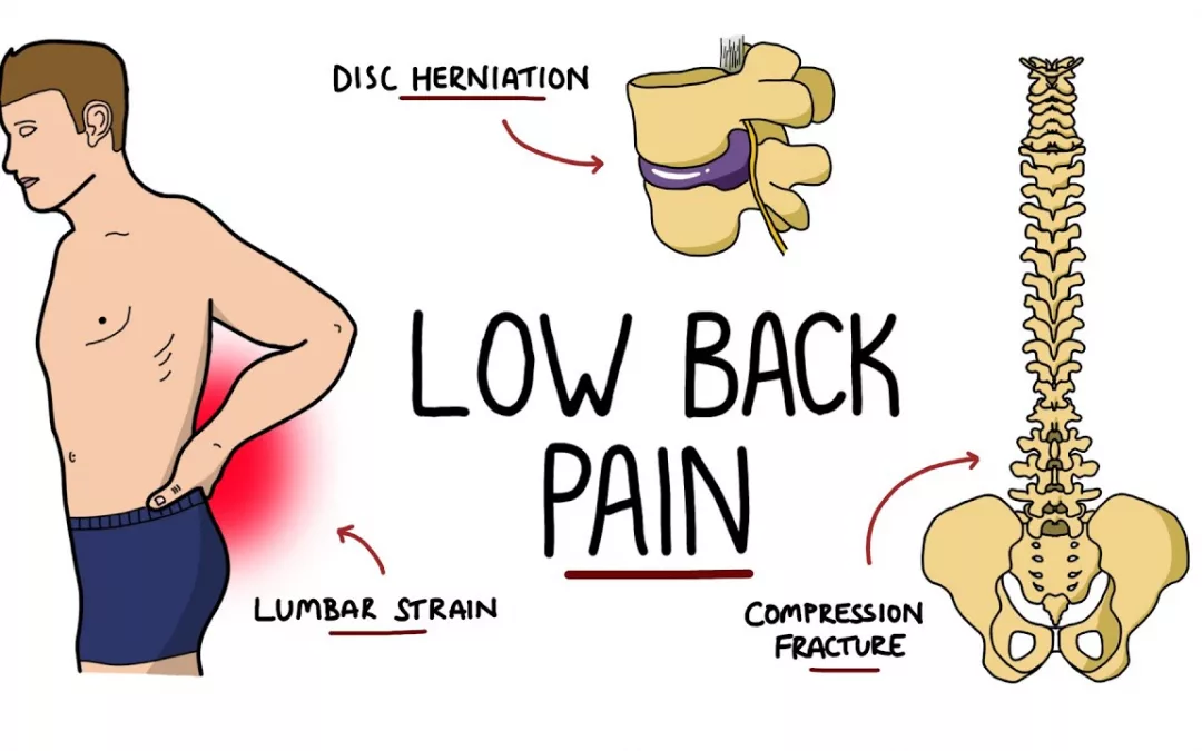 Low Back Pain and/or Nerve Impingement - Structura Body Therapies