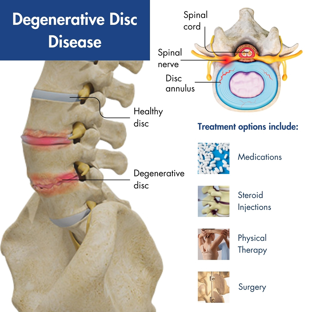Degenerative Disc Disease (DDD)