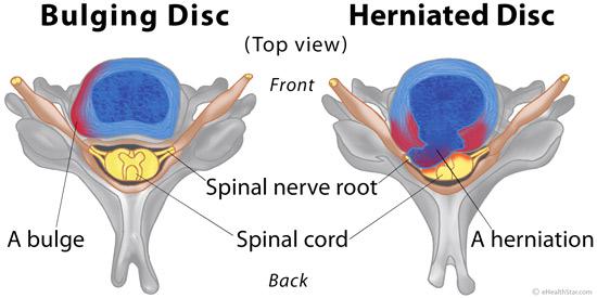 Herniated or Bulging Disc