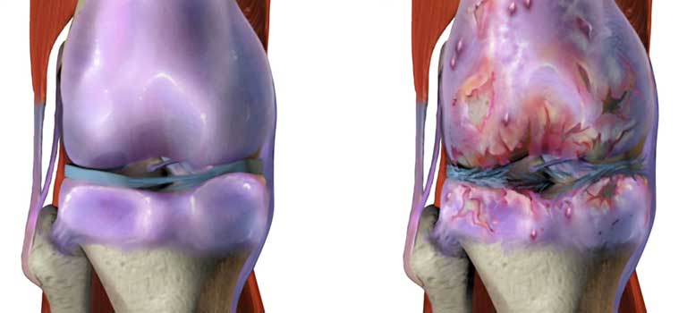Osteoarthritis