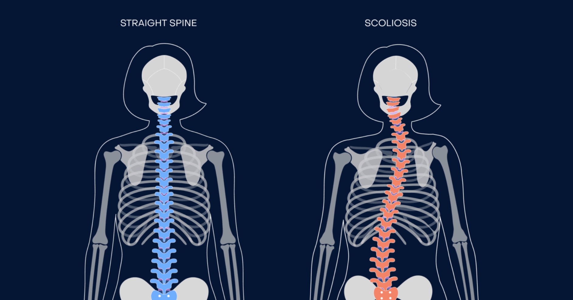 Scoliosis