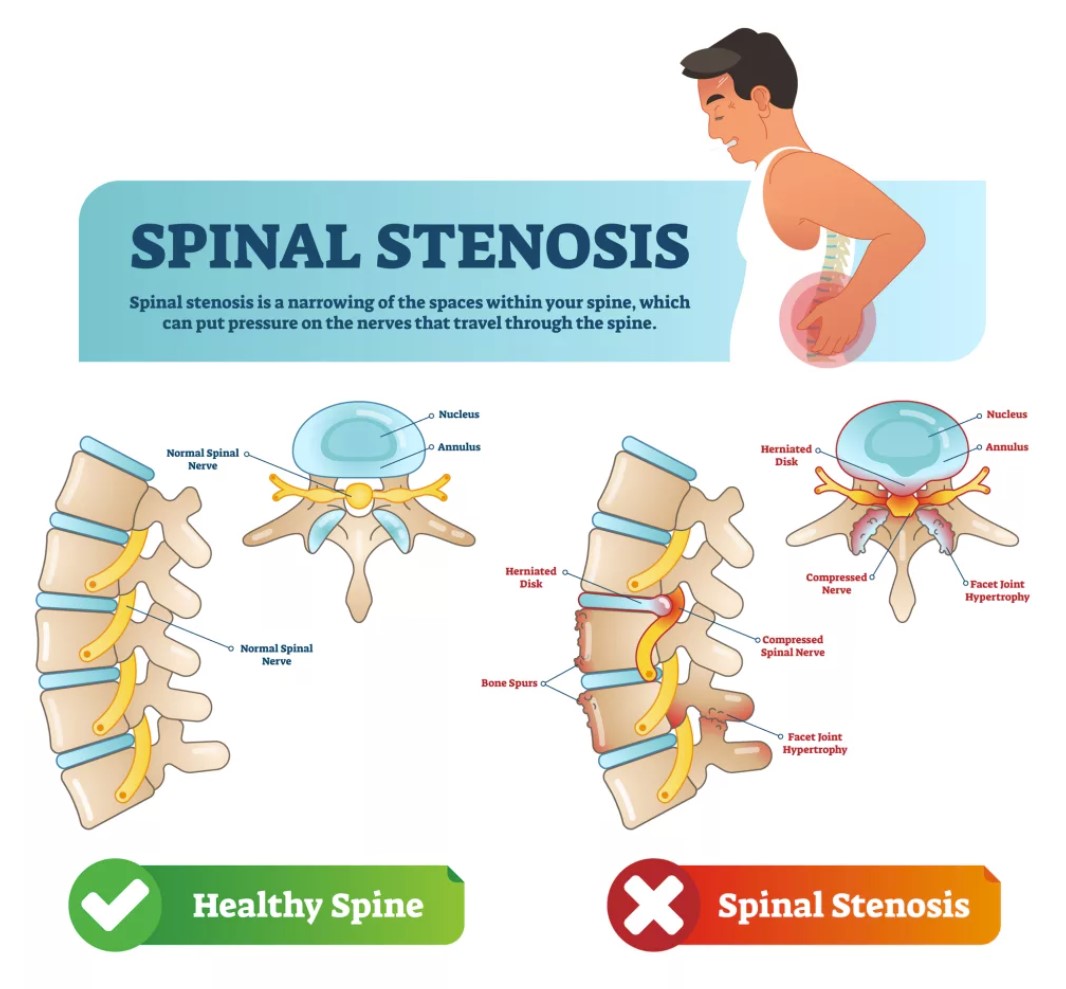 Spinal Stenosis