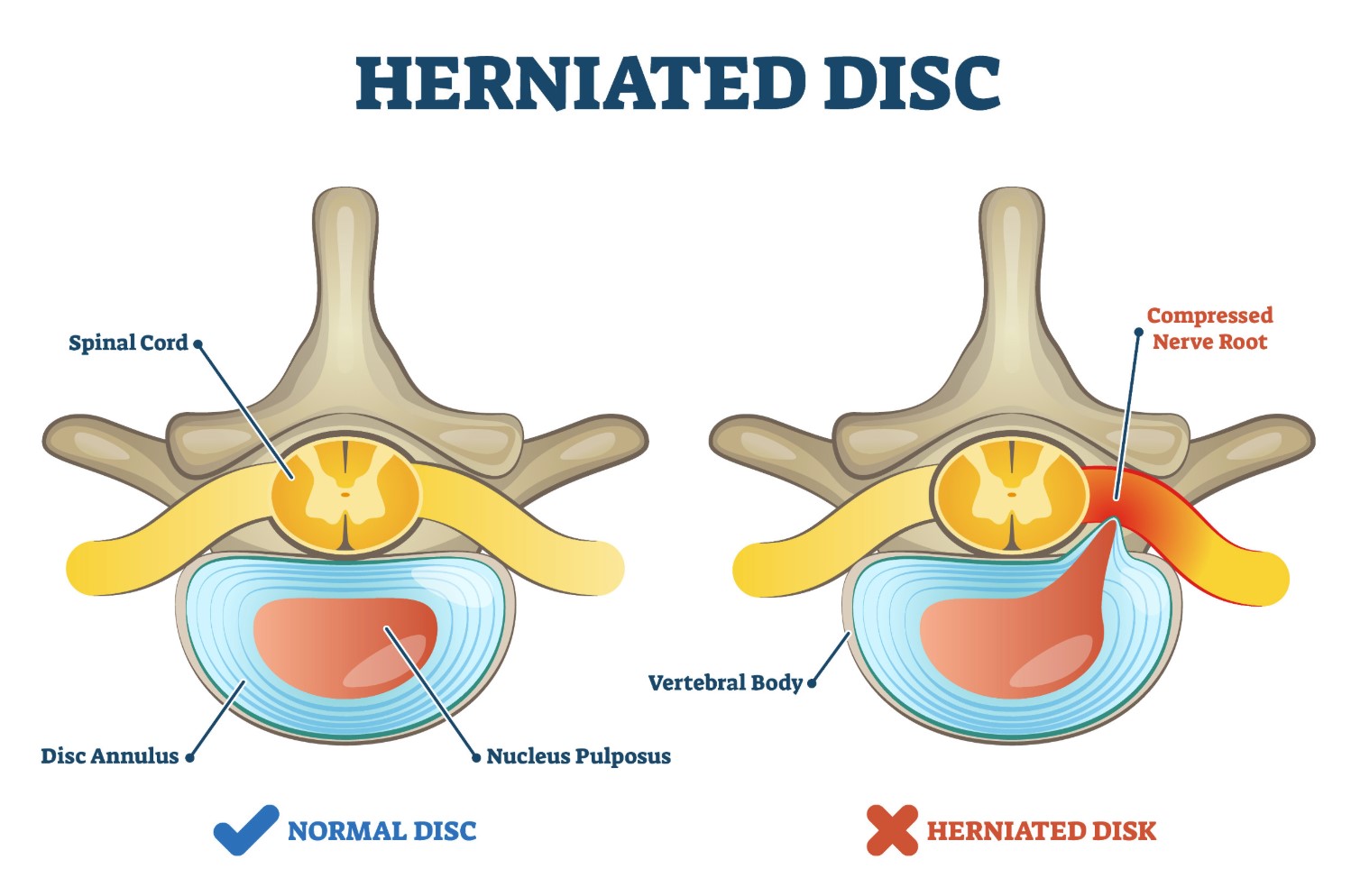 what is a herniated disc
